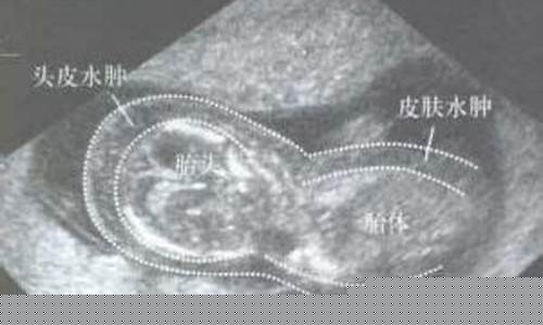 胎儿水肿是什么？